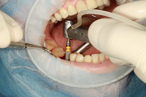 dental-implant-being-performed