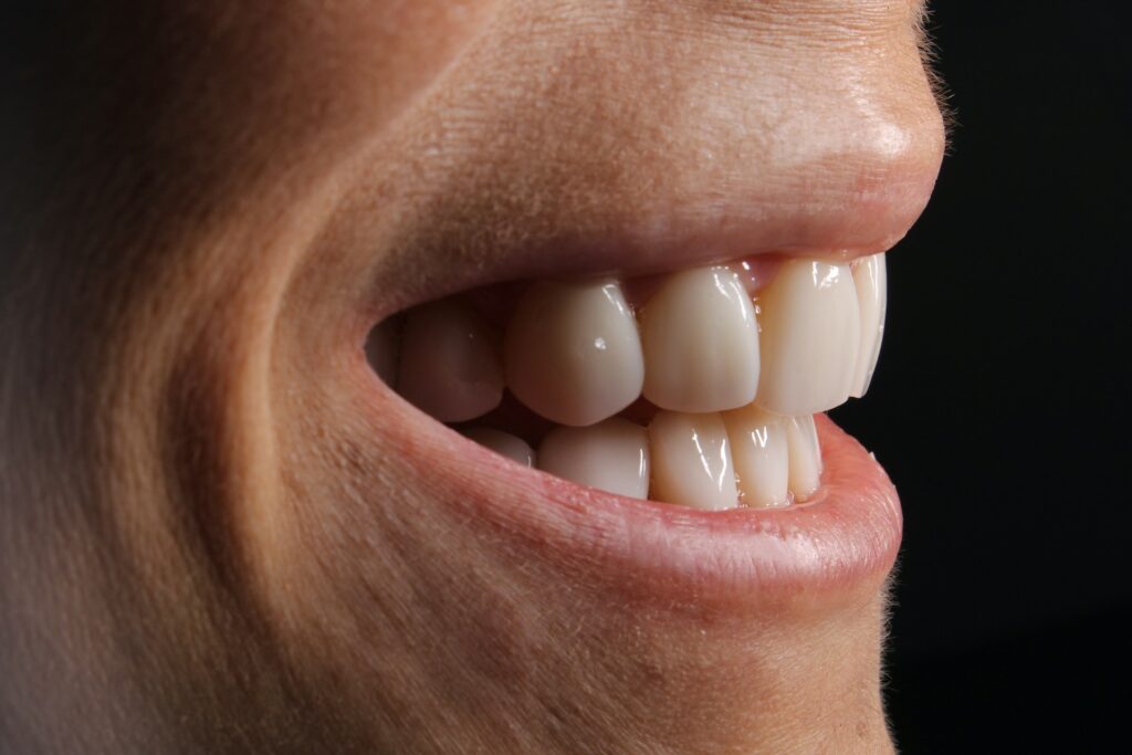 veneers